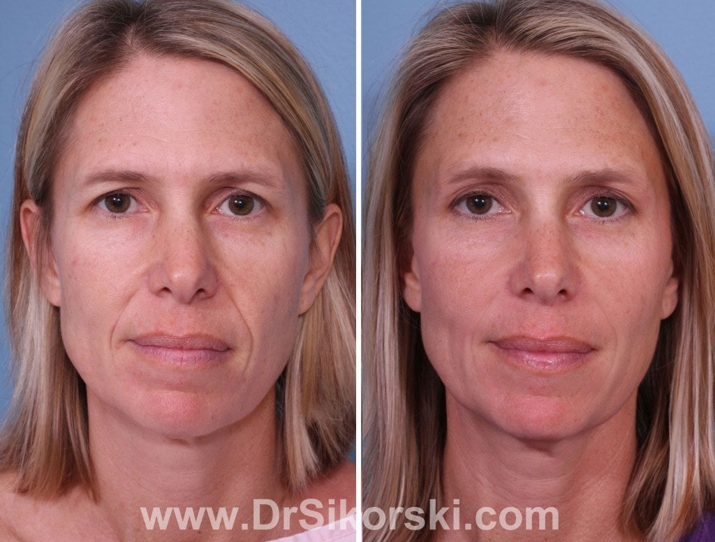 Restylane-Lyft-Orange-County-Patient-1-1
