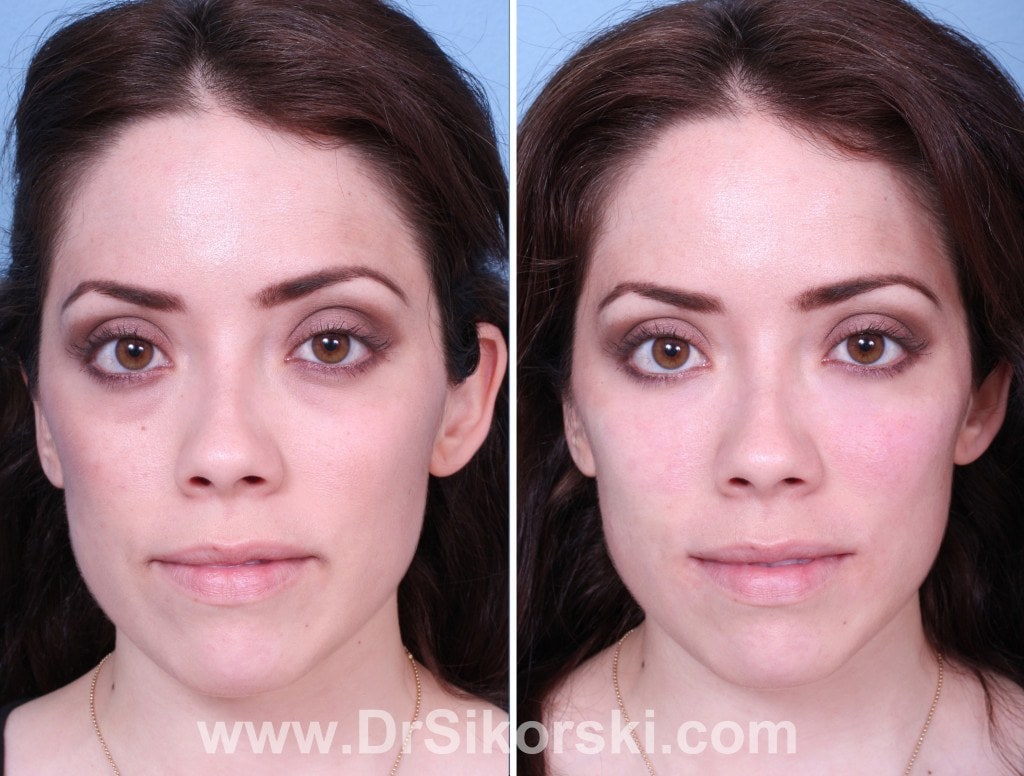 Restylane-Orange-County-Patient-1