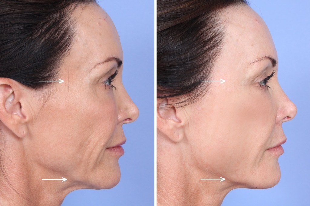 Sculptra-Orange-County-Patient-1