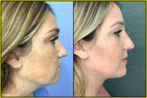 Patient after neck lift