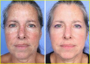 Woman after Thulium treatment