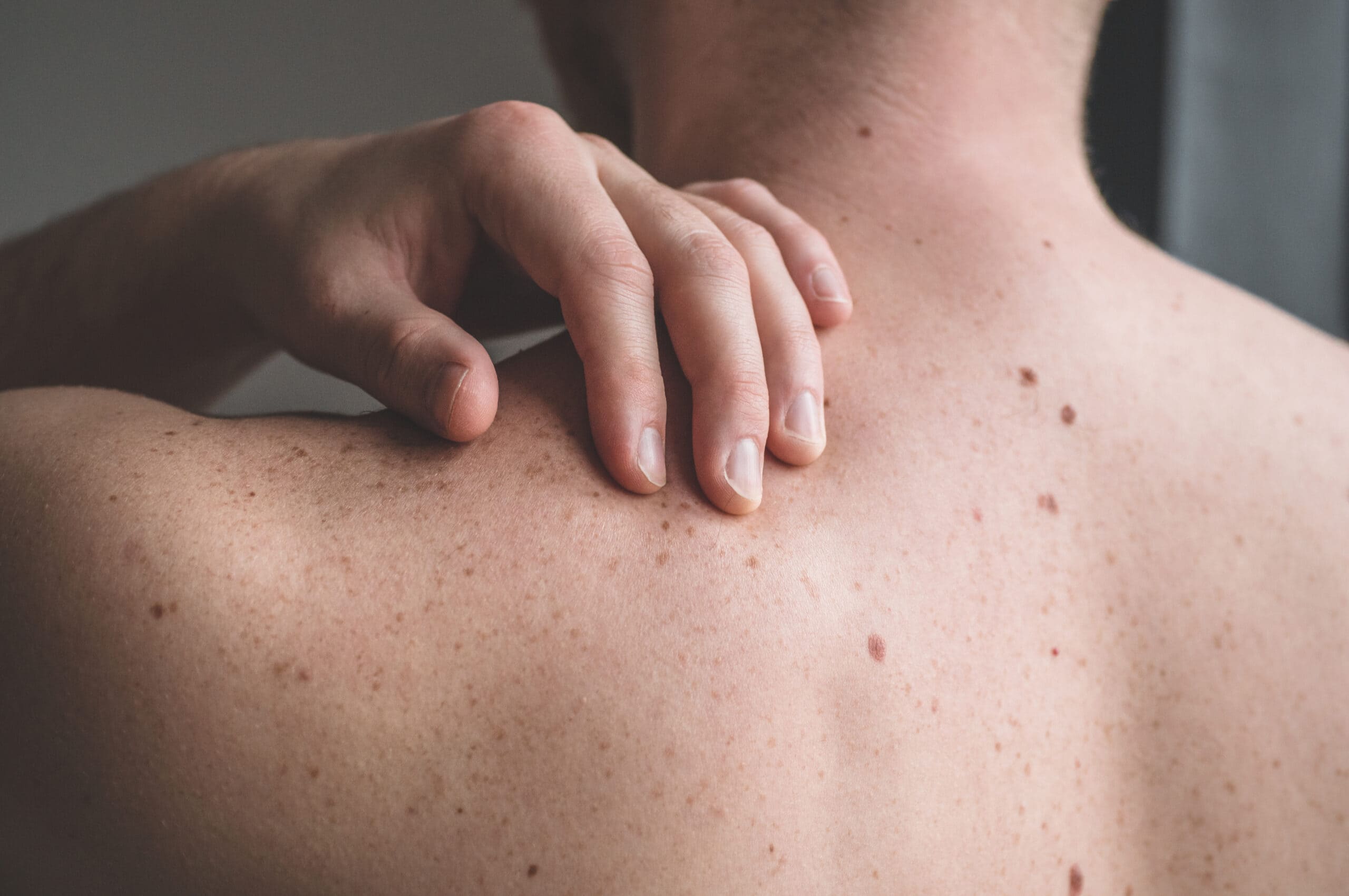 How To Prevent and Treat Skin Cancer