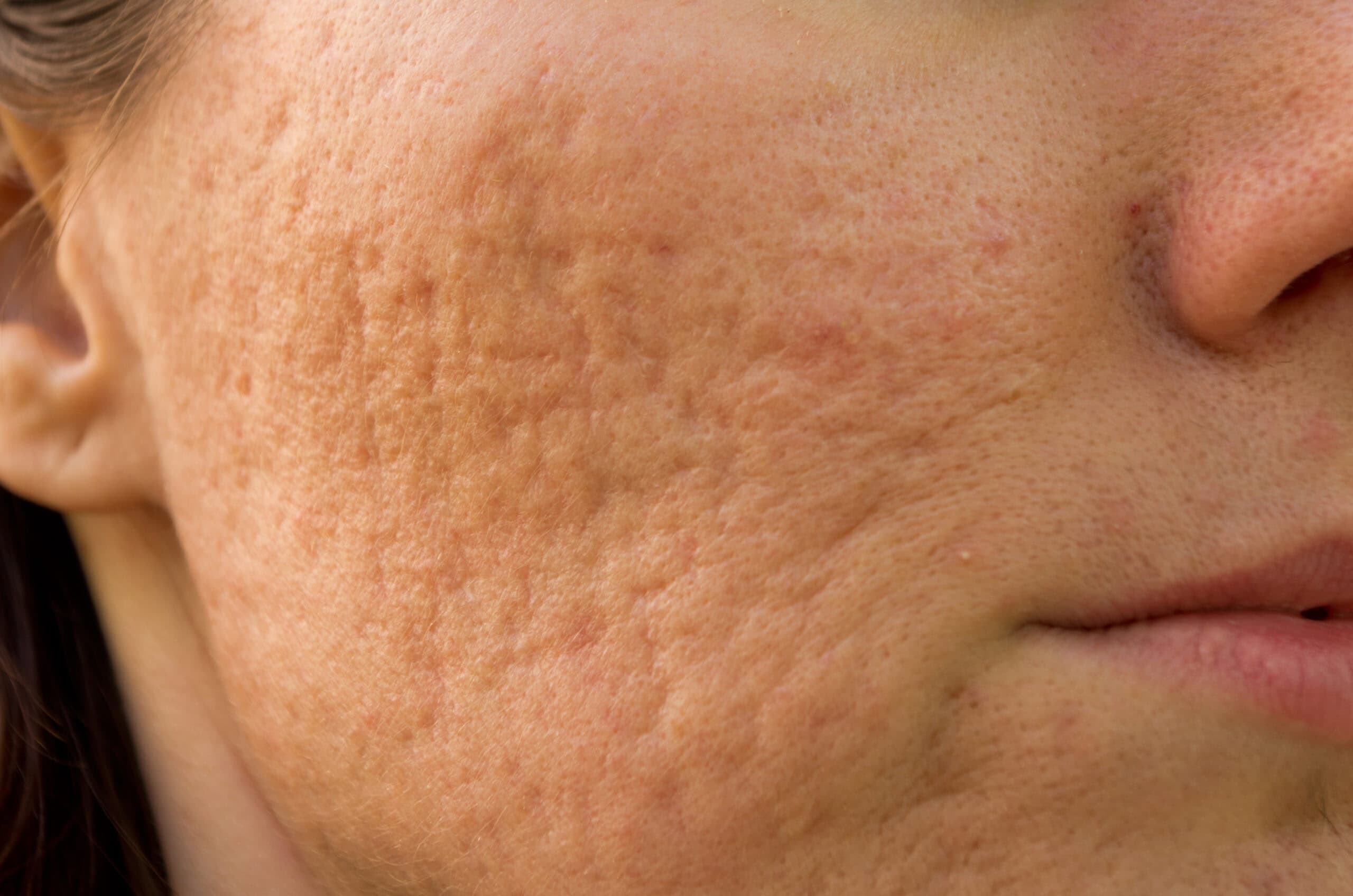 Depressed Acne Scar Treatments: Restoring Smooth Skin Texture
